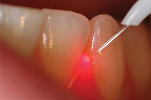 Laser Gum Treatment1
