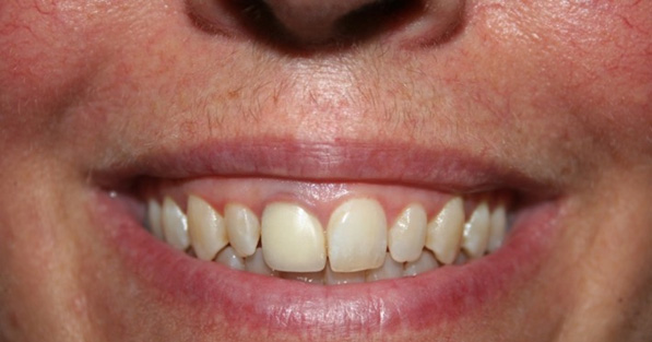 Cosmetic Gum Dentistry