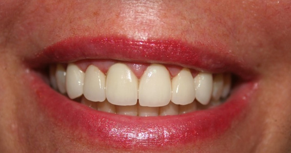Cosmetic Gum Dentistry2
