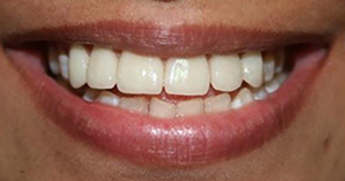 Smile Restoration with Porcelain Laminates 2
