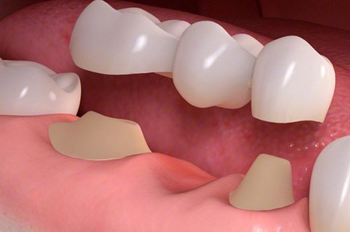 Dental Bridge Implant