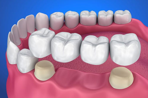 3 teeth dental bridge