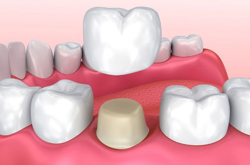 Tooth Crown Implant