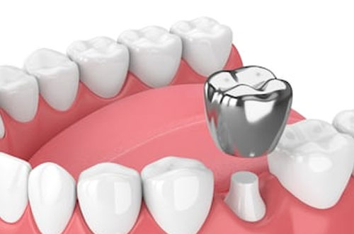 Silver Tooth Crown Implant