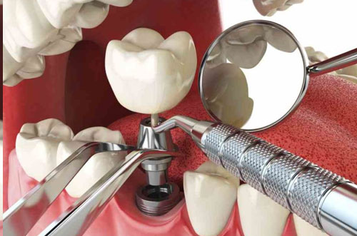 Single tooth implant