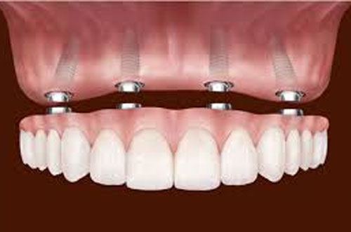 Full mouth denture implant