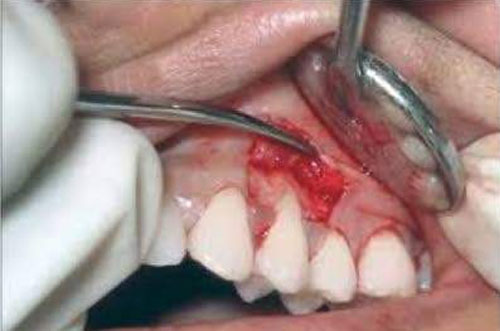 Gum Flap Surgery