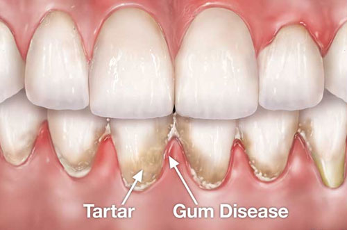 Gum Flap Treatment