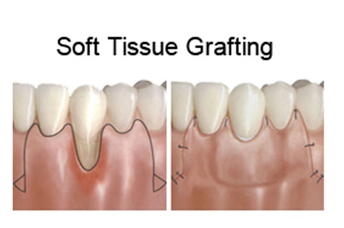 Bone Grafting Dental Surgery