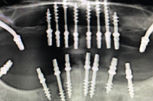Basal Implant Xray