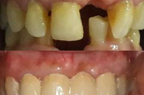 Smile Restoration through teeth bridge