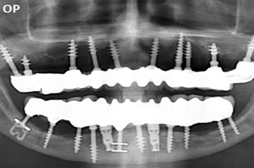 Xray of dental implants