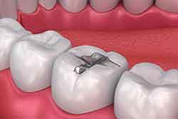 Tooth filings