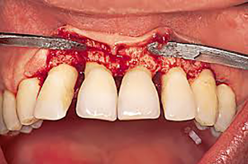 Gum Flap Surgical Operation