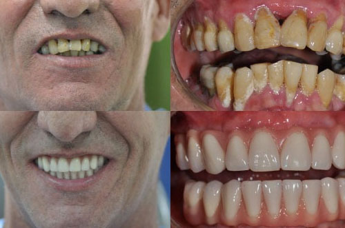 Full Mouth Dental Implants Results