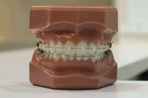 Full Mouth Denture with Braces for Teeth Alignment