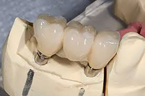 Porcelain Dental Bridge Diagram