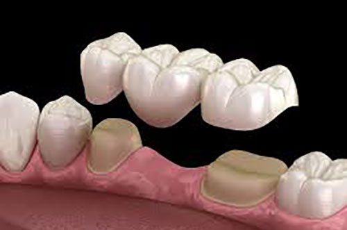 Porcelain Dental Bridge
