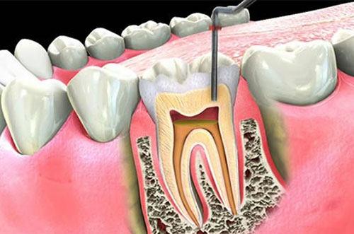 Root Canal Operation