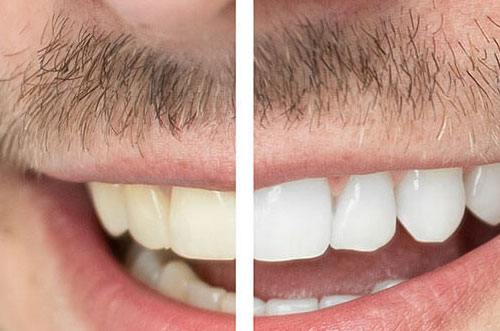 Teeth Whitening Comparison Photograph