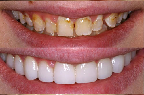 Teeth Whitening Service Results